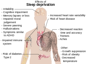 sleep deprivation2 - Sleep - Is It REALLY That Important?